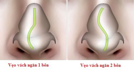 VẸO VÁCH NGĂN MŨI