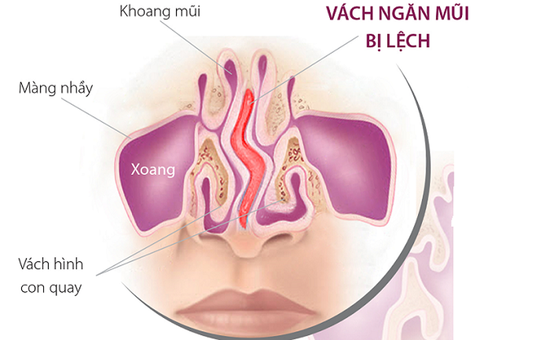 VẸO VÁCH NGĂN MŨI