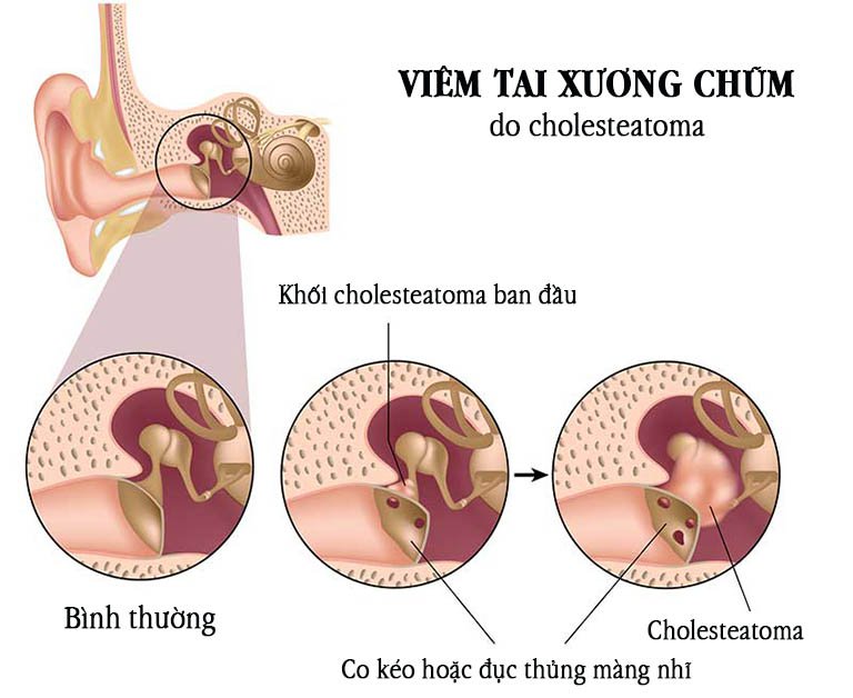 VIÊM TAI XƯƠNG CHŨM CÓ NGUY HIỂM?