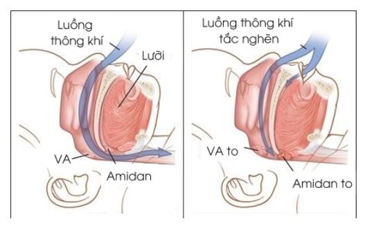 Ngủ ngáy chẳng phải chuyện đùa - Phòng khám kỹ thuật cao Phoenix