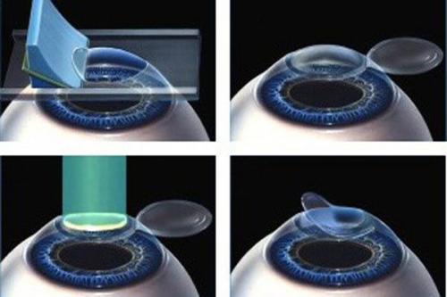 NGUYÊN NHÂN TÁI CẬN SAU MỔ LASIK VÀ CÁCH PHÒNG TRÁNH