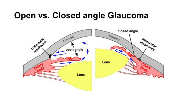 Các loại bệnh tăng nhãn áp và cách điều trị