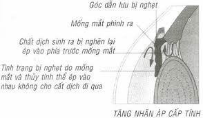 Các loại bệnh tăng nhãn áp và cách điều trị